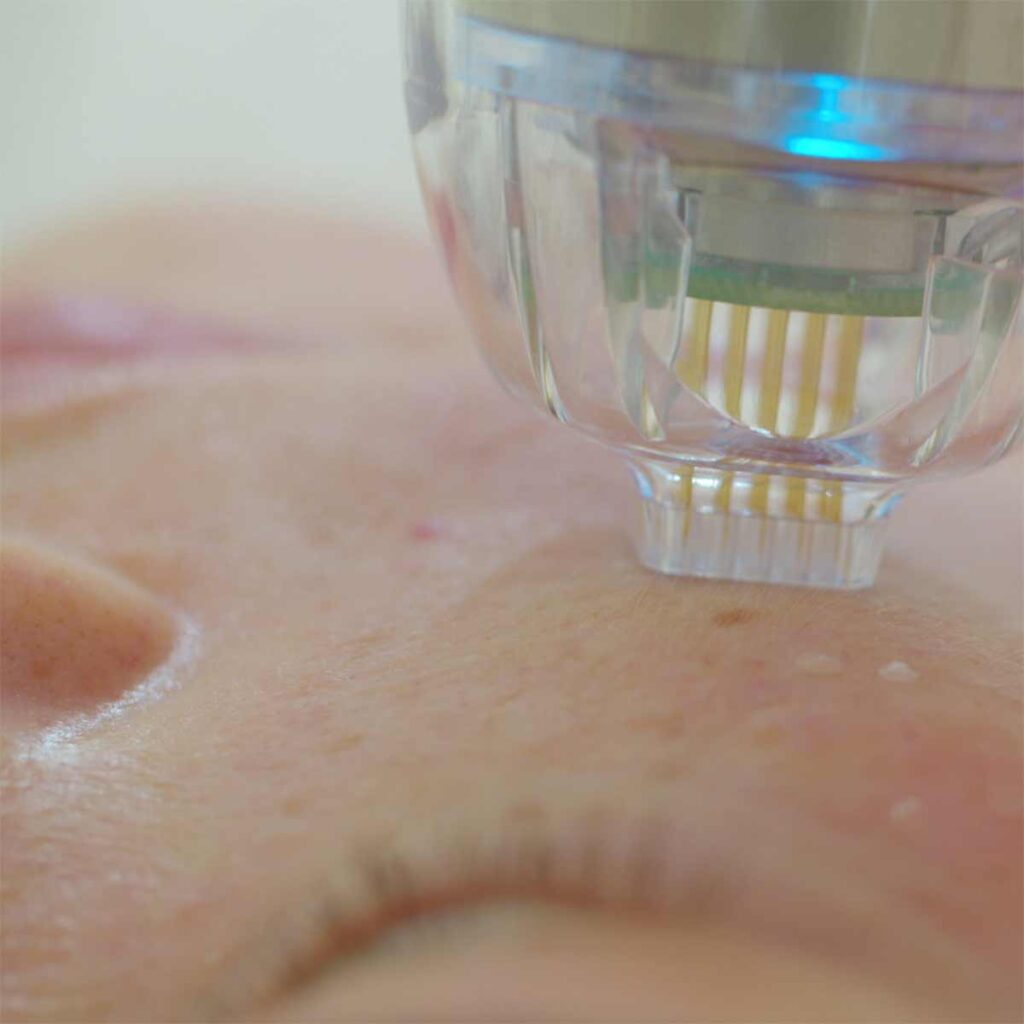 vivace application on face